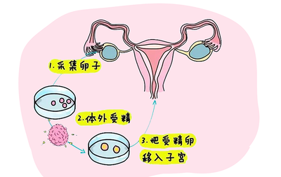 不孕不育只能做试管婴儿么?