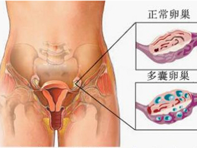 除了不孕,关于多囊卵巢综合征的你还要了解这些内容!