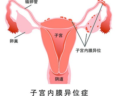 什么是子宫内膜异位症?医生:真正令人担心的是容易造成不孕