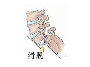腰椎间盘突出怎么治 专业腰腿痛治疗推荐