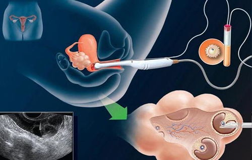 当不孕症遇上早泄 双重困扰的应对策略