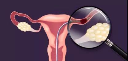 流产与不孕症的关联 原因与机制解析